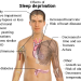 Sleep and Its Impact on Your Physical Therapy 640px-Effects_of_sleep_deprivation.svg