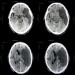 Stroke Warning Signs: Know it When You See it 11345348_s